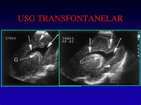 ecografia transfontanelara|Transfontanelar Ultrasound Technique, Normal Anatomy